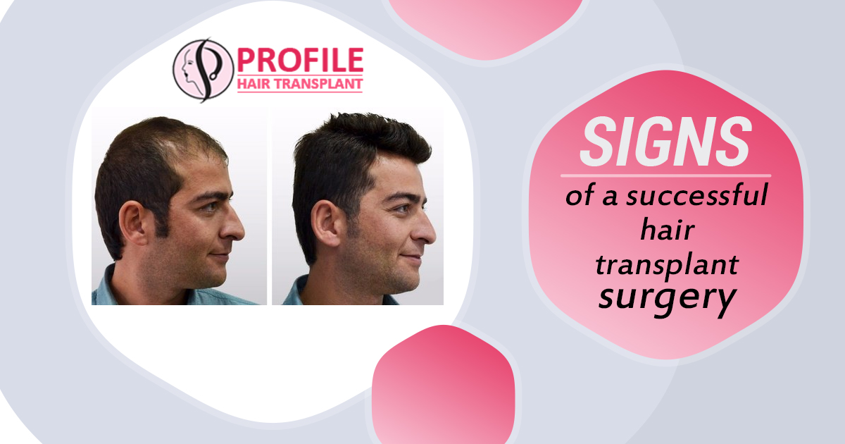 Signs of A Successful Hair Transplant Surgery