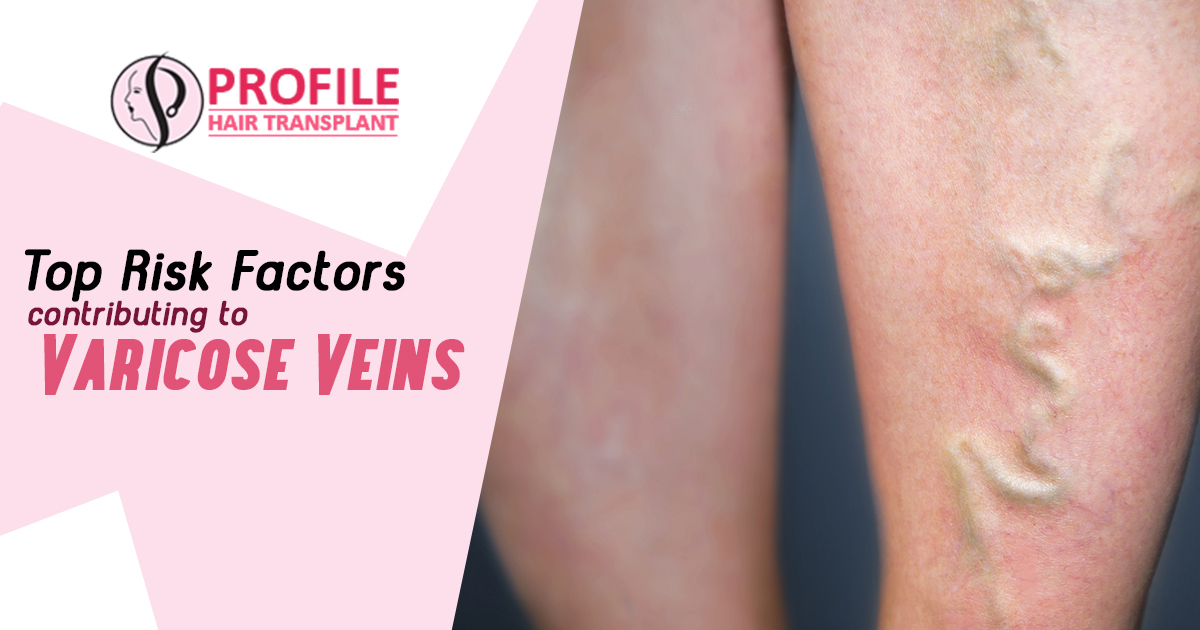 Top Risk Factors contributing to Varicose Veins