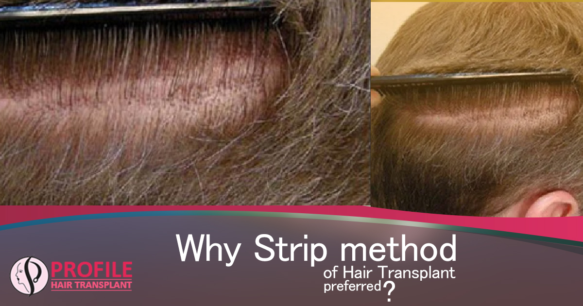 Why Strip method of Hair Transplant is preferred?