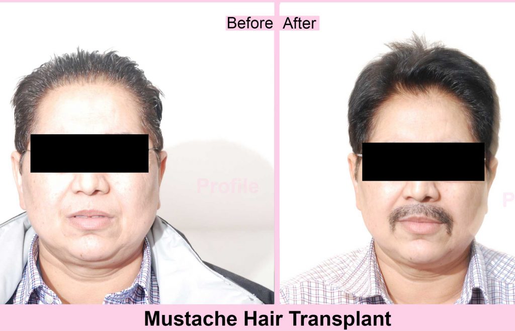 Hair Transplant in Ludhiana, Punjab