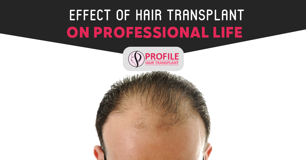 Effect of Hair Transplant On Professional Life