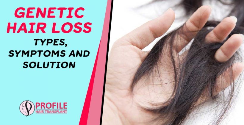 Genetic Hair Loss: Types, Symptoms and Solution
