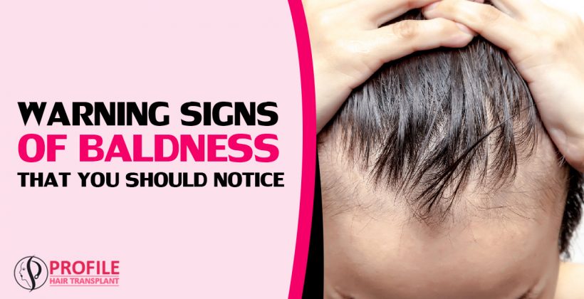 Warning Signs of Baldness That You Should Notice