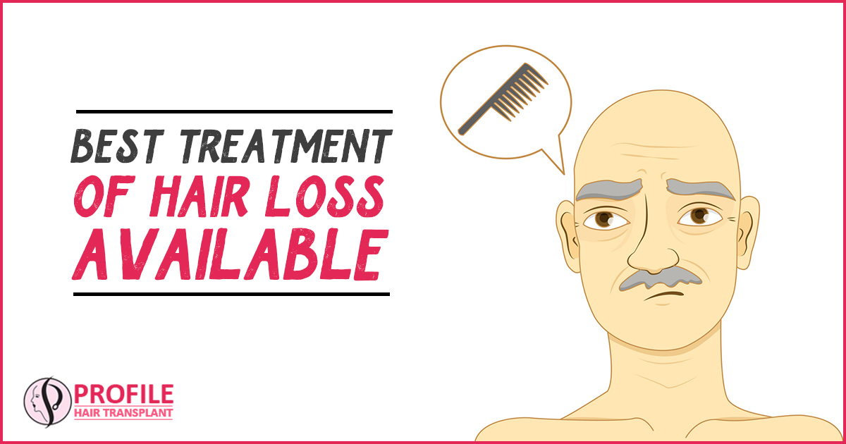 Best Treatment of Hair Loss Available