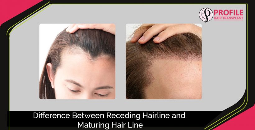 Difference Between Receding Hairline And Maturing Hair Line