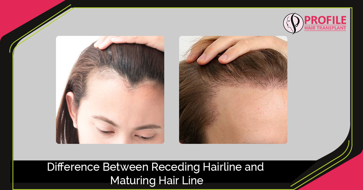 Receding hairline Vs Maturing Hairline