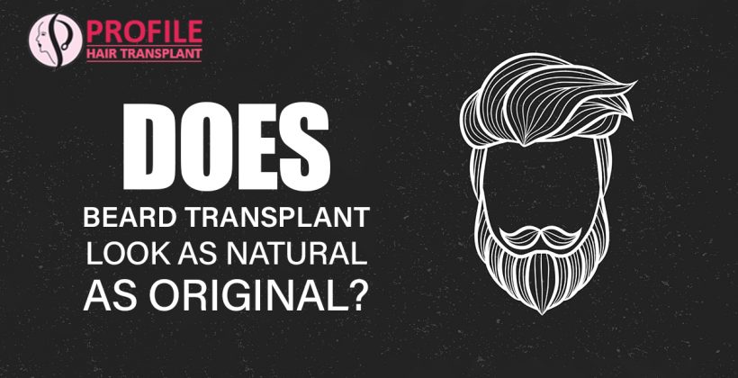 Does Beard Transplant Look As Natural as Original?