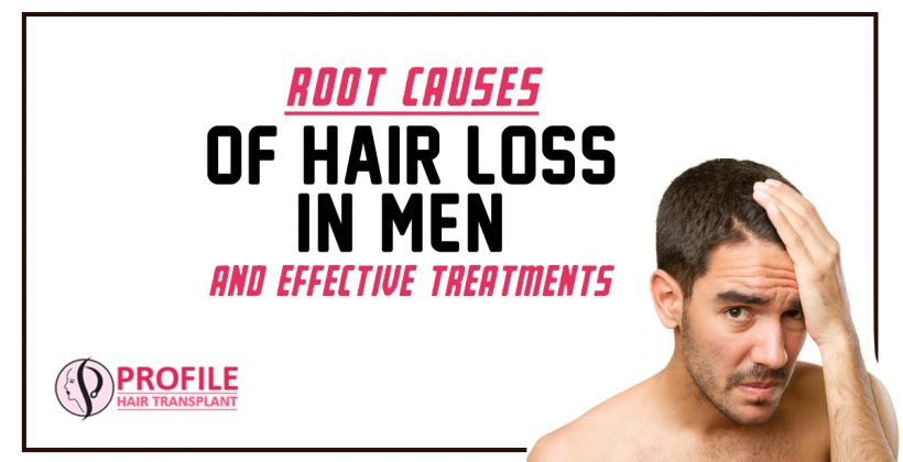Root Causes Of Hair Loss In Men And Effective Treatments