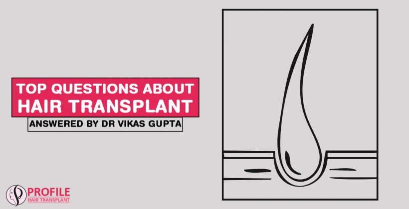 Top Questions About Hair Transplant Answered by Dr Vikas Gupta