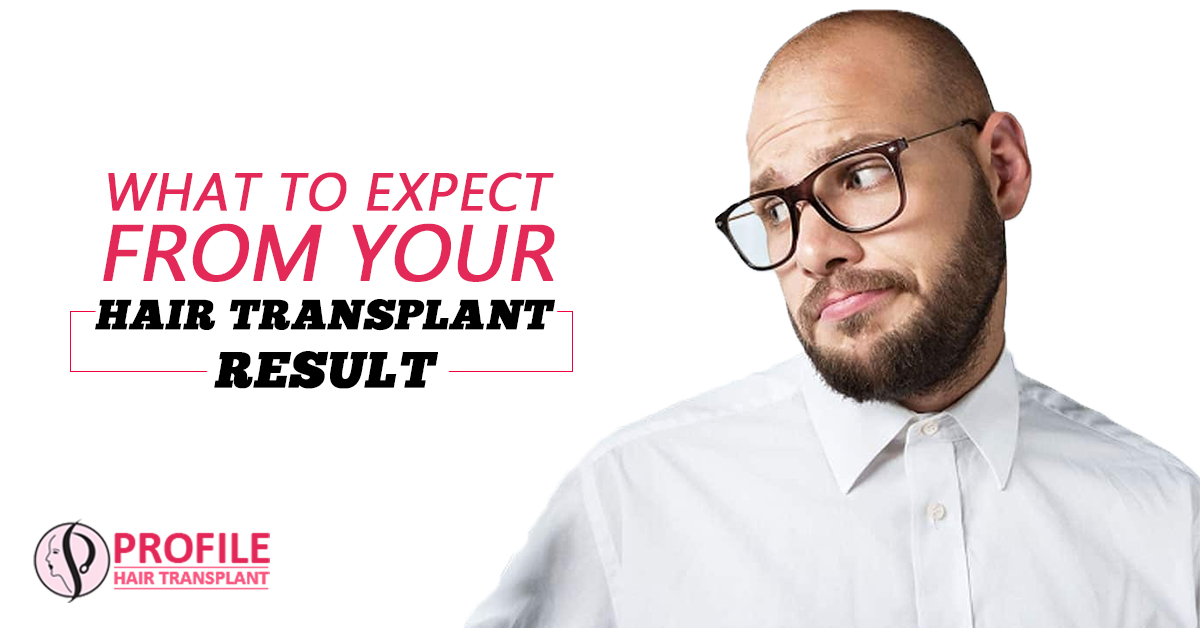 What To Expect from Your Hair Transplant result?