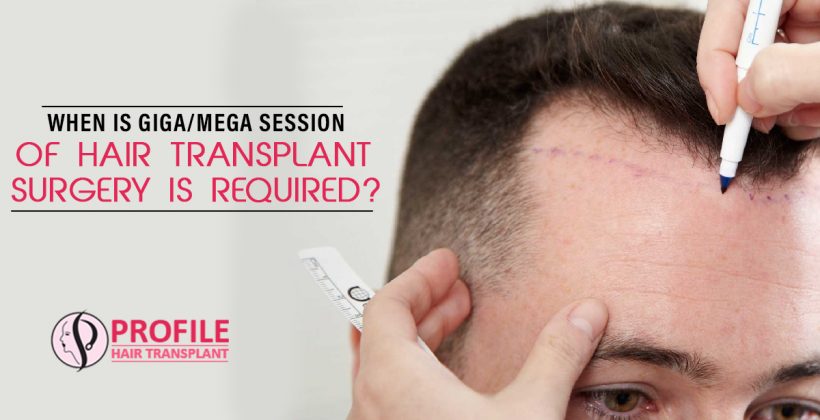 When is Giga/Mega Session of Hair Transplant Surgery is Required?
