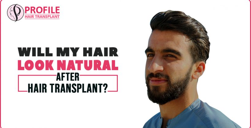 Will My Hair Look Natural After Hair Transplant?