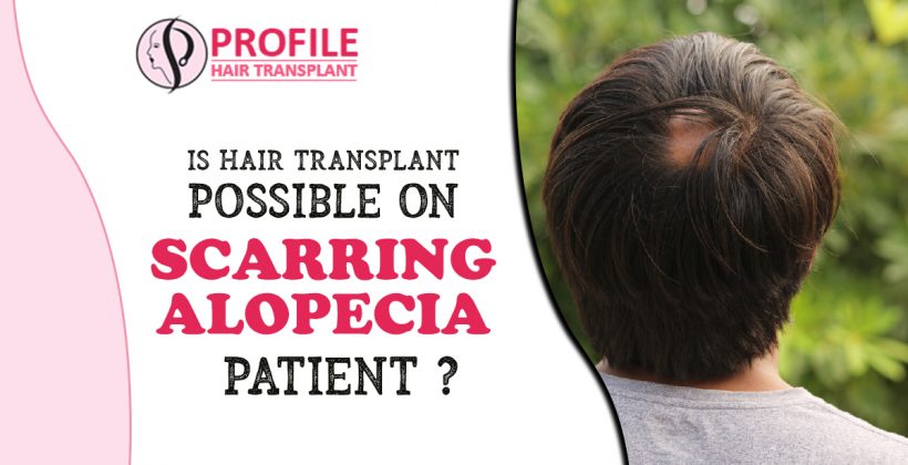 Is Hair Transplant Possible On Scarring Alopecia Patient?