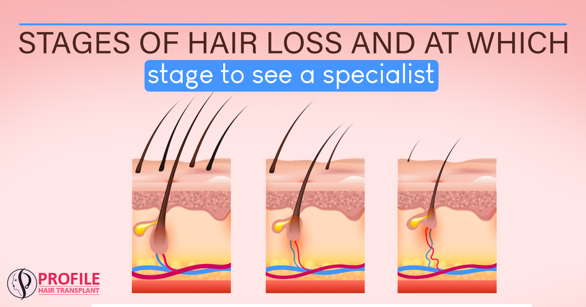 Stages of Hair Loss And At Which Stage To See A Specialist