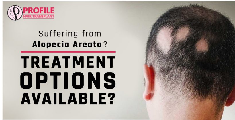 Suffering from Alopecia Areata? Treatment options Available?