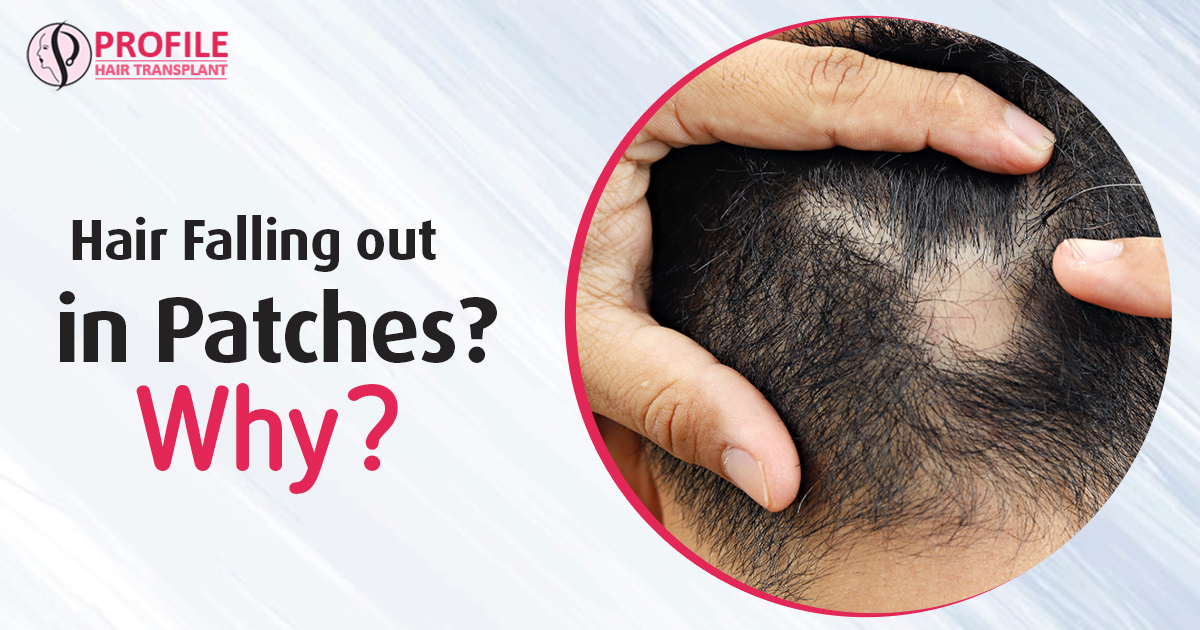 Why Does Hair fall Out in Patches?