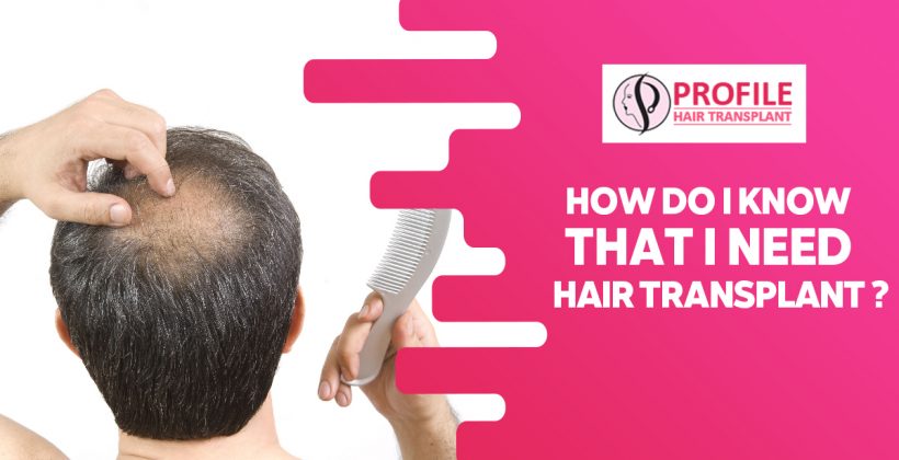 How do I Know that I Need Hair Transplant?