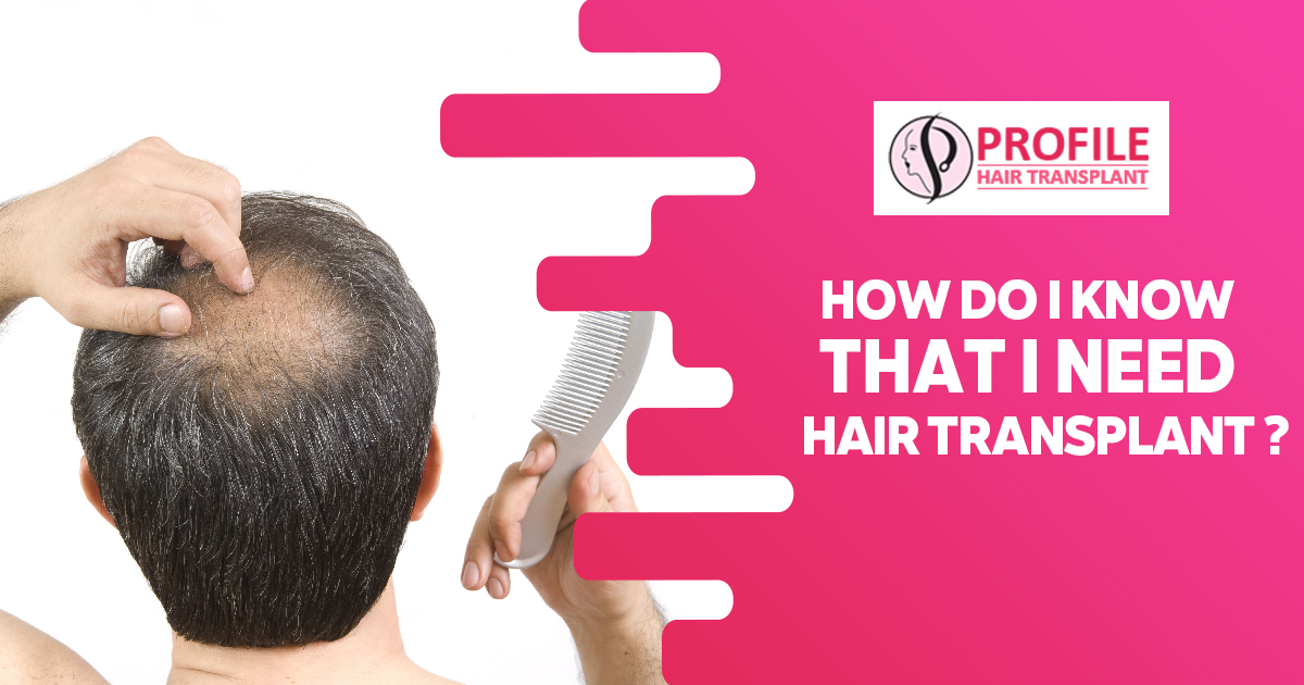 How do I Know that I Need Hair Transplant?