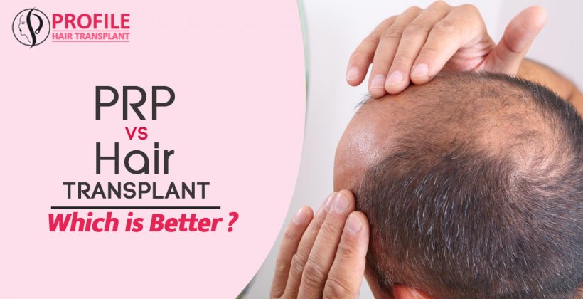 PRP VS Hair Transplant Which is Better?