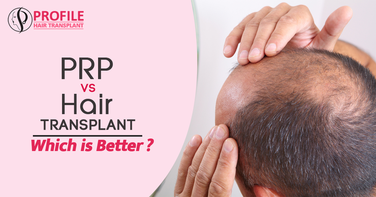 PRP VS Hair Transplant Which is Better?