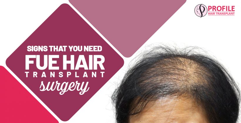 Signs that You Need FUE Hair Transplant Surgery