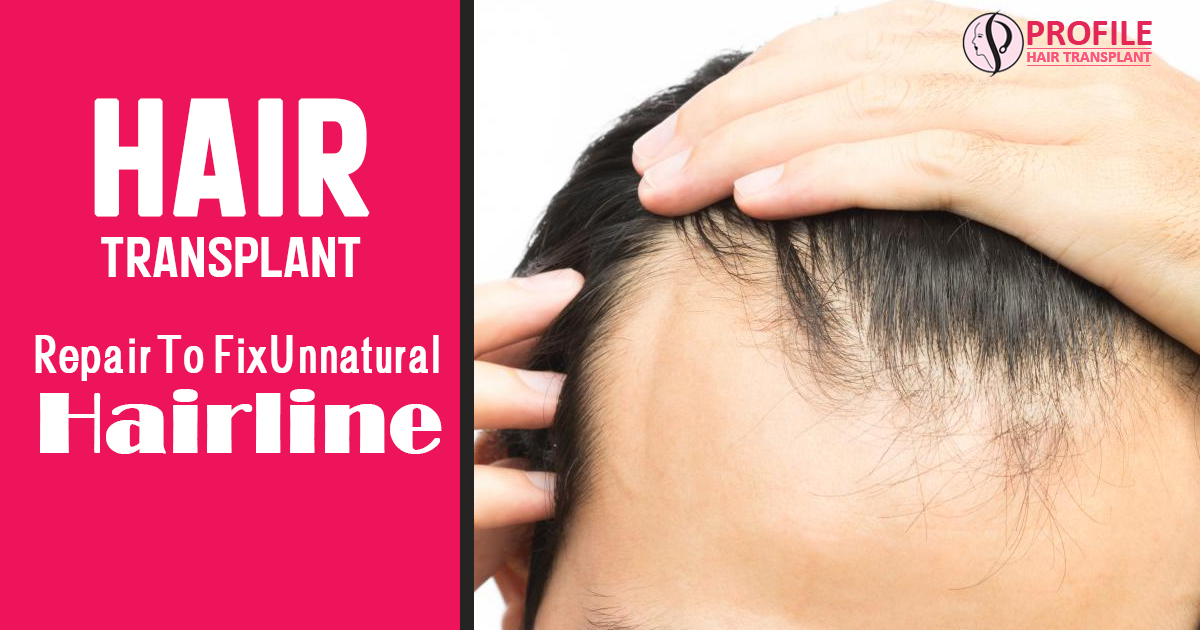 Hair Transplant Repair To Fix Unnatural Hairline