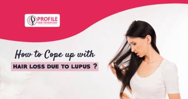 How to Cope up with hair loss due to lupus?
