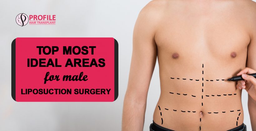 Top Most Ideal Areas for Male Liposuction Surgery