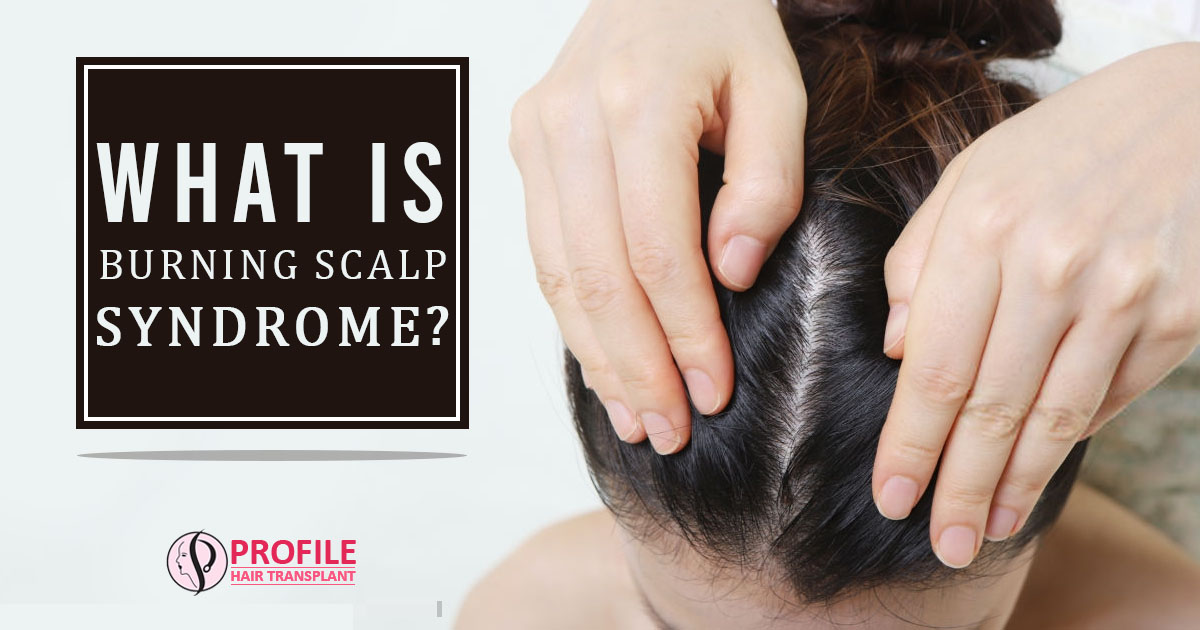 What is burning Scalp Syndrome?