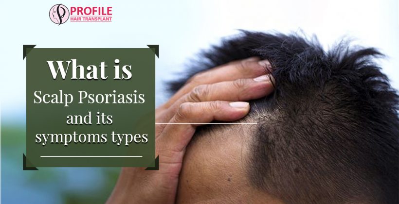 What is Scalp Psoriasis and its Symptoms, Types