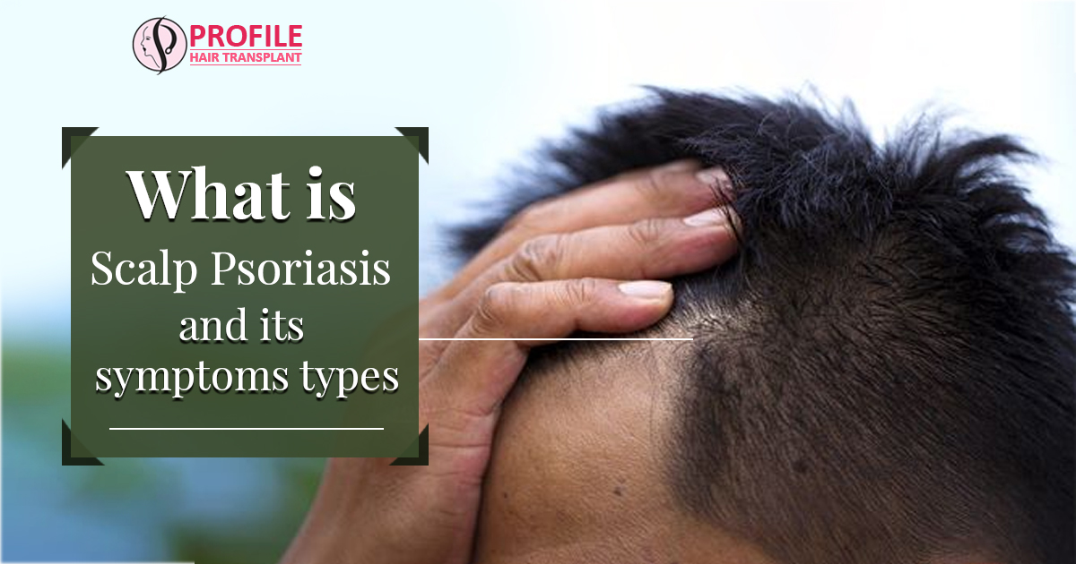 What is Scalp Psoriasis and its Symptoms, Types