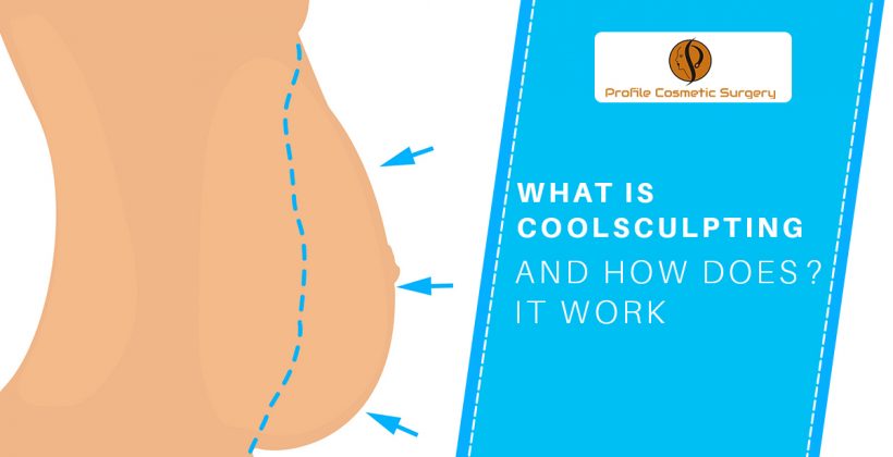 What is Coolsculpting and How does it Work?
