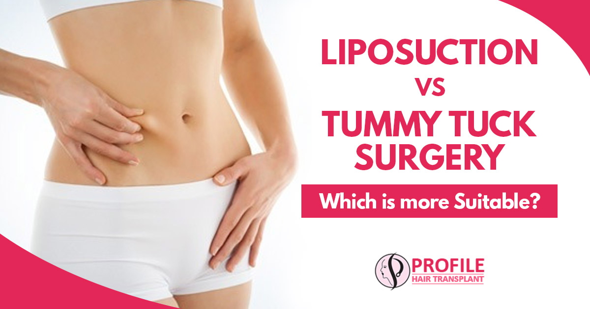 Liposuction vs Tummy Tuck surgery : Which is more suitable?