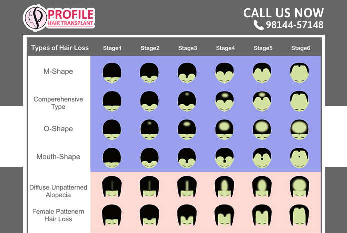 Detailed Information About Male Pattern Baldness