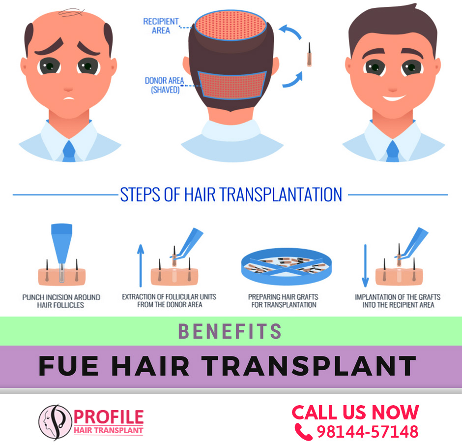 https://profilehairtransplant.com/wp-content/uploads/2020/01/fue-hair-transplant-2.jpg