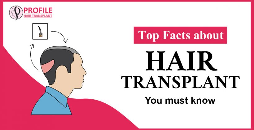 Top Facts about Hair Transplant You must know
