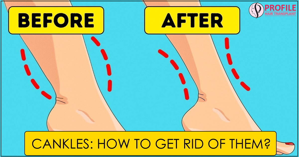 Cankles How To Get Rid Of Them