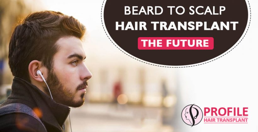 Beard to Scalp Hair Transplant – the Future