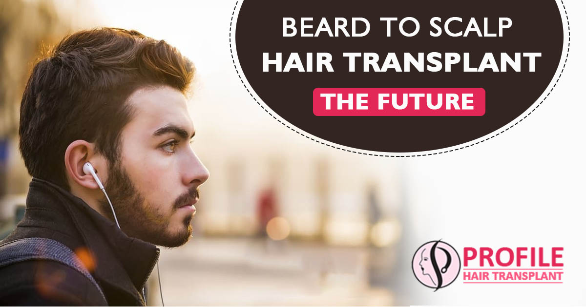 Beard to Scalp Hair Transplant – the Future