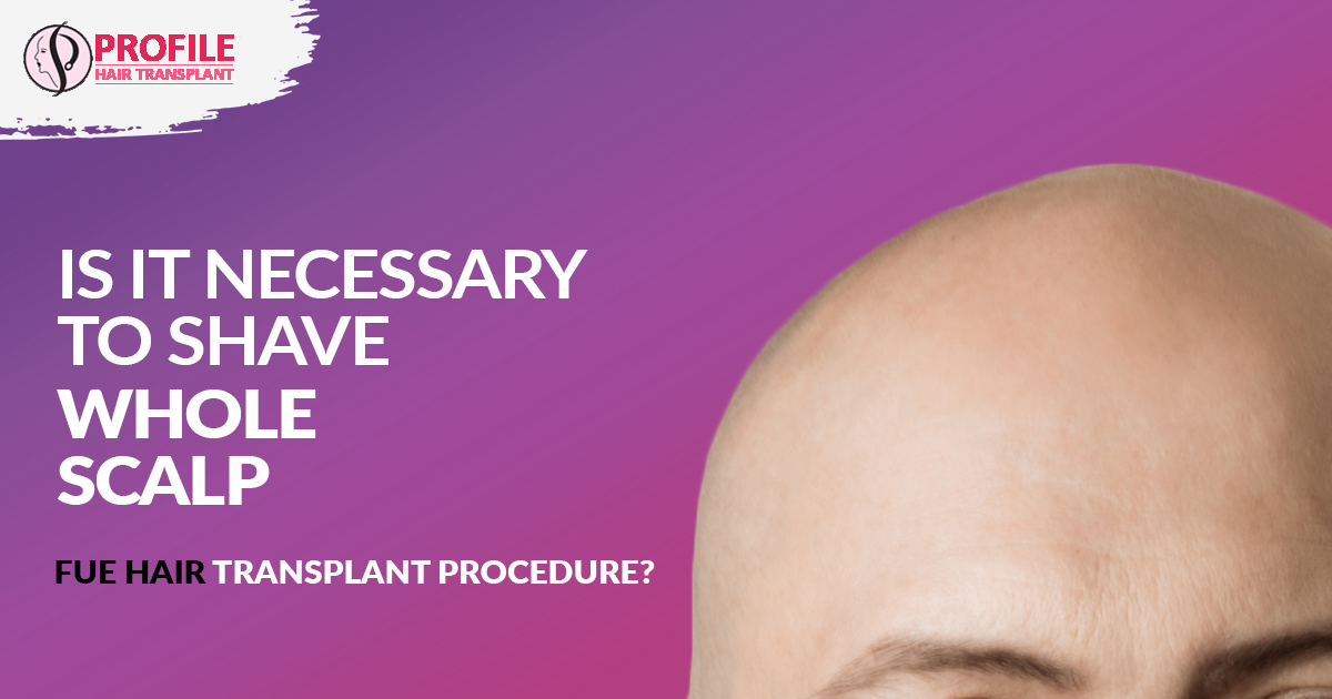 Is it necessary to shave the whole scalp before undergoing an FUE hair transplant procedure?