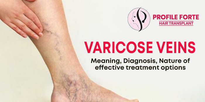 Varicose veins: Meaning, Diagnosis, Nature of effective treatment options