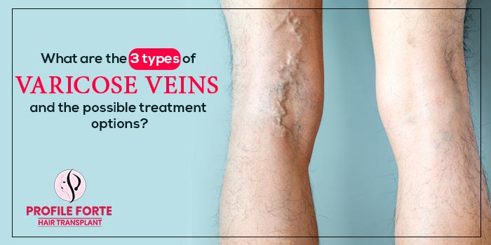 What are the 3 types of varicose veins and the possible treatment options?