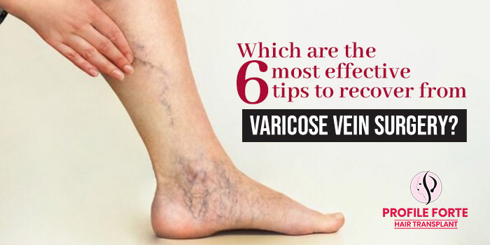 Which are the 6 most effective tips to recover from varicose vein surgery?