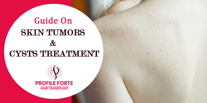 Guide on Skin Tumors & Cysts Treatment