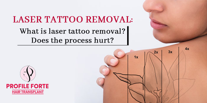 Laser tattoo removal: What is laser tattoo removal? Does the process hurt?