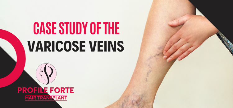 What do you know about the varicose veins? How can this be treated?