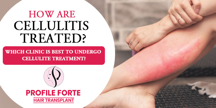 How are cellulitis treated? Which clinic is best to undergo cellulite treatment?