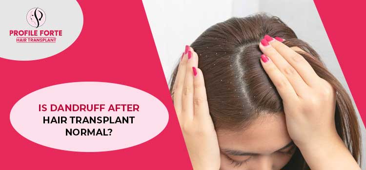 What to do if dandruff comes about in the initial month after the hair transplantation?