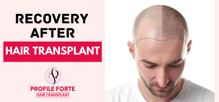 When is it possible to cover the head after getting a hair transplant?