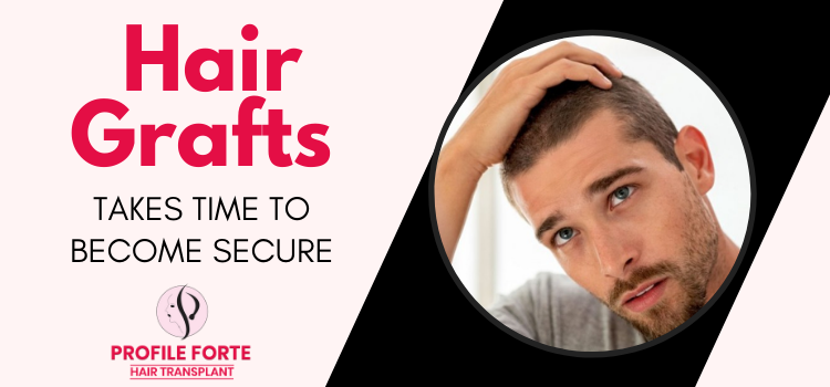 Optimal results once the hair grafts become secure after hair transplant